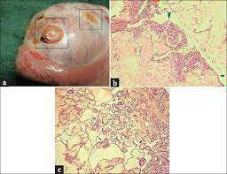 This is the most advanced stage. Malignant Mesothelioma Of Testis A Report Of Three Cases And Review Of Literature Priyadarshi N Bhat S Paul F Shetty S Med J Dy Patil Vidyapeeth