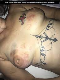 Bruised Tit Torture | BDSM Fetish
