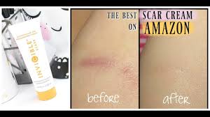 Silagen scar cream is one of the best on the market. The Best Scar Cream On Amazon Invicible Scars Advanced Scar Treatment Youtube