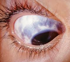 Image result for melanosis sclera