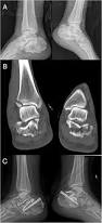 Image result for Calcaneus Compression Fracture