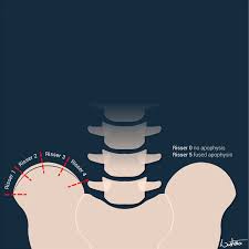 Image result for Risser Sign