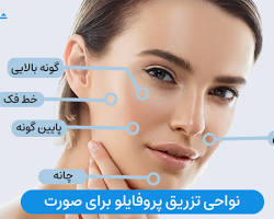 Image of تزریق پروفایلو در خط فک