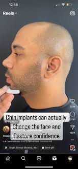 bruce spotted liking a chin implant instagram reel, surgery coming? :  r/BruceDropEmOff