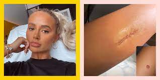 Maria trimarchi moles can appear at any time during your life. Molly Mae Hague Had Surgery To Remove Potentially Cancerous Mole