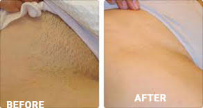 At caddell's laser clinic, we are able to completely remove the entire facial hair out of all the hair removal clinics that i have been to, there has been none that have treated me with anything close to the respect, kindness and. Laser Hair Removal Pros Since 2001 Get Hair Less