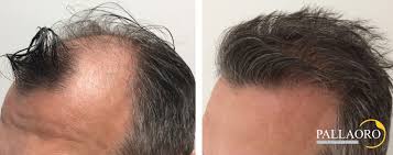 Cosa fare dopo il trapianto di capelli: Trapianto Capelli Foto Prima Dopo Prima Dopo Micro Fue Clinica Pallaoro