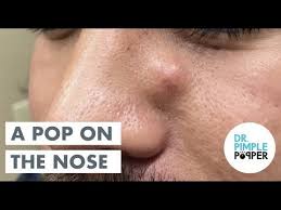 Pimple popping videos are so gross, yet somehow, they're also satisfying. Doctor Pimple Popper Youtube Pimples On Face How To Cure Pimples Pimples