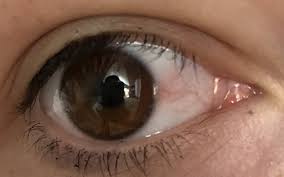 Hier erfahren sie mehr über ursachen, symptome, behandlung und vorbeugung des gerstenkorns. Was Ist Das Auge Rot Augen Augenarzt Rotes Auge