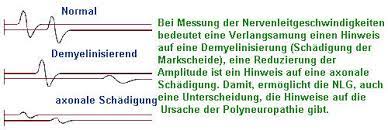 Emg Elektromyogramm Nlg Nervenleitgeschwindigkeiten