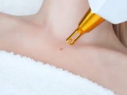 4 Tipos De Manchas En La Piel Y Cómo Eliminarlas | Instituto Fotomedicina