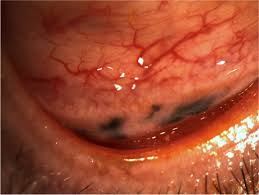 Image result for nevus sclerae