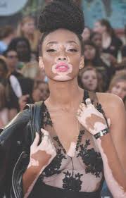 Model With Vitiligo Beats The Haters To Win Two Major Fashion Campaigns 19 Year Old Canadian Model Winnie Vitiligo Model Chantelle Brown Young Winnie Harlow