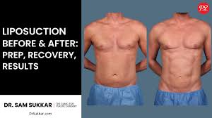 Image result for Liposuction