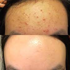 Fungal acne responds to antifungal treatments. B A Found Out I Had Fungal Acne For The Longest Time And Finally Got Rid Of It By Using The Right Products This Time Tretinoin Asianbeauty