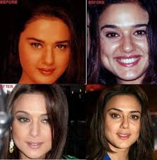 Bollywood Celebrities Plastic Surgery And Botox Celebrity Plastic Surgery Bollywood Celebrities Plastic Surgery A)bollywood actresses like priyanka chopra and anushka sharma learned new skills and trained but dancing to hit item numbers.being the botox queen. bollywood celebrities plastic surgery