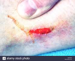 Frische Blutige Stelle In Der Haut Hasslichen Blauen Fleck Am Bein Detaillierte Erschossen Die Offene Wunde Vor Dem Gips In Ambulancy Stockfotografie Alamy