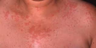 Hypocomplementemic Urticarial Vasculitis In Mixed Connective Tissue Disease