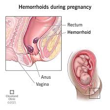 Hemorrhoids While Pregnant: Causes, Prevention & Treatment