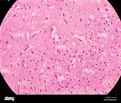 Image result for Tropical Edema