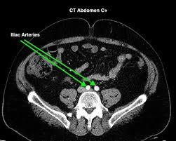 Image result for CT Intravenous Contrast