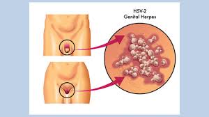 People who have ingrown hair issue can have sex, but those having herpes issue should avoid contact if they have symptoms. What Is Herpes And How Do I Know If I Have It Theindependentbd Com