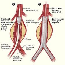 Pin On Aortic Aneurysms