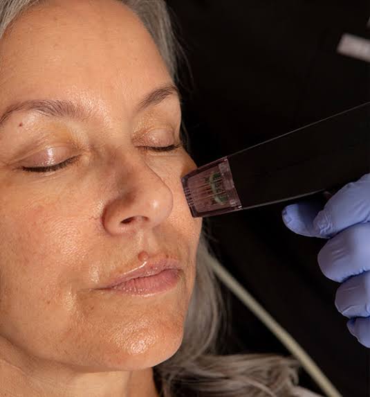 Morpheus8 Phoenix | Skin Tightening Scottsdale, AZ