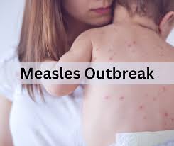 Image result for measles