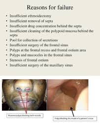See more of nasal polyp removal on facebook. Nasal Polyp Removal Surgery Risks Can You Remove Nasal Polyps Yourself