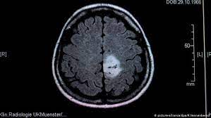Signs of a brain tumor. Brain Tumors In Children When All That Matters Is Now Science In Depth Reporting On Science And Technology Dw 08 06 2020