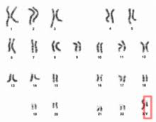 An example of an autosomal recessive condition is cystic it is caused by a faulty recessive allele on chromosome 7. Y Chromosome Wikipedia