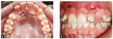 The difference in time required for the two techniques was statically significant (p = 0.000). Scielo Brasil Orthodontic Traction Of Impacted Maxillary Canines Using Segmented Arch Mechanics Orthodontic Traction Of Impacted Maxillary Canines Using Segmented Arch Mechanics