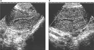 Sonographic Appearances Of The Endometrium After Termination Of Pregnancy In Asymptomatic Versus Symptomatic Women Mcewing 2009 Journal Of Ultrasound In Medicine Wiley Online Library
