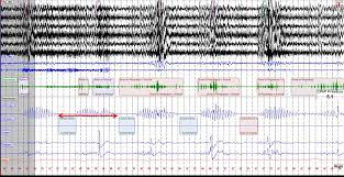 Image result for Cheyne-Stokes Respiration
