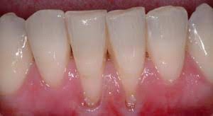 Receding Gums And Treatment Brisbane Today S Dentistry