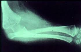 Image result for Radial Head Dislocation