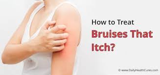 Bruises That Itch 11 Home Remedies To Treat Itchy Bruises Itching Skin Bruises Itch
