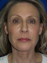 Skin Laser in Toledo