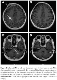 Metastatic brain tumors (also called secondary brain tumors) are caused by cancer cells spreading cancer can also spread to the spine (metastatic spine tumors). Brain Metastases From Breast Cancer May Respond To Endocrine Therapy Report Of Two Cases Oncology Nurse Advisor