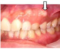 「歯科 骨隆起 画像」の画像検索結果
