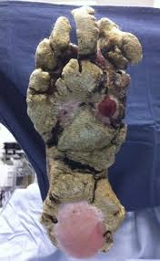 Image result for scabies norvegica