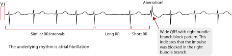 atrial fibrillation ecg classification causes risk