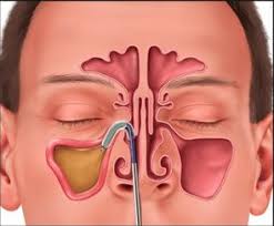 Sinus Surgery Sinuplasty A New Less Invasive Surgery Sinus Surgery Sinusitis Ent Doctor