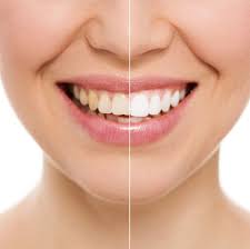 Bleaching your hair makes it lighter and blonder by chemically reducing the amount of pigment in your hair's strands. Behandlungsspektrum Bleaching Sagadent Zahnarzt Munchen