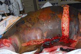 Patient has a change in burn wound appearance or character, such as rapid eschar separation, or dark brown, black, or violaceous discoloration of the eschar, or oedema at wound margin cambio del aspecto o el carácter de la lesión, como la rápida separación de escaras , su decoloración marrón oscura, negra o violácea o la aparición de un. Burns Clinical Advisor