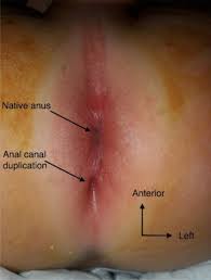 Clinical aspect of anal canal duplication | Download Scientific Diagram
