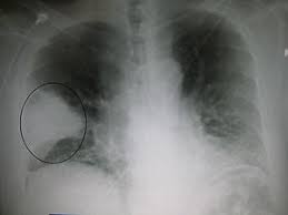 Bacterial pneumonia is also considered to be severe when it is accompanied by extension outside the lung parenchyma, when lung necrosis or septicemia develops, or when it occurs in patients with comorbid diseases. Pneumonia Wikipedia A Enciclopedia Livre