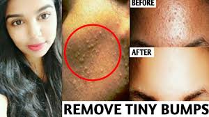 Milia appearance, causes, and treatment are different than acne. How To Get Rid Of Tiny Bumps On Forehead Or Face Natural Home Remedy Milia Home Remedy Youtube