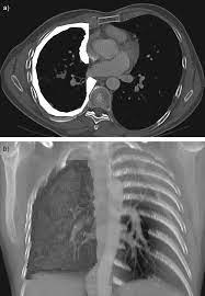 Learn about this uncommon cancer that's linked to asbestos exposure. Volumetry An Alternative To Assess Therapy Response For Malignant Pleural Mesothelioma European Respiratory Society